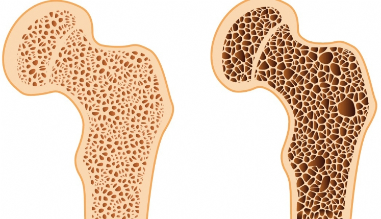 Osteoporose: o que é e como tratar?