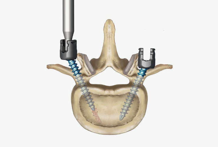 Artrodese Posterolateral